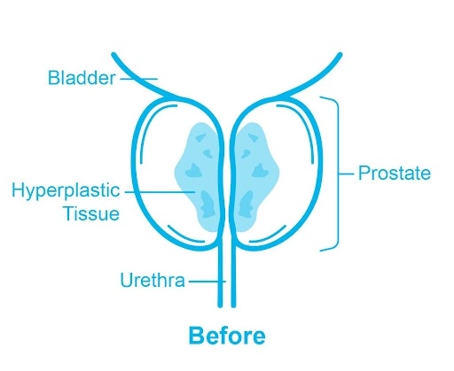 blocked prostatic urethra