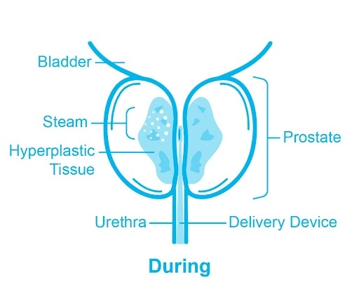 alternative to prostatic urethral lift