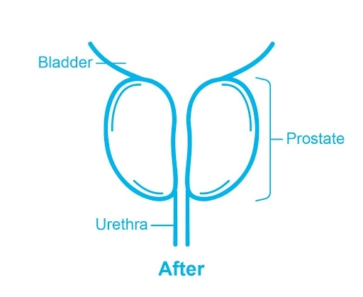 preventing chronic urinary retention