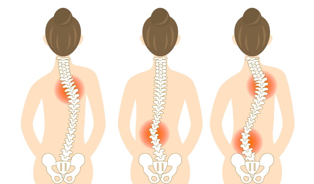 spinal curve of mild scoliosis and moderate scoliosis