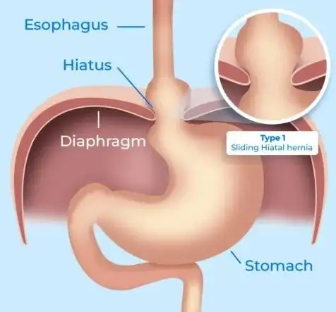 BEYOND THE BURN UNDERSTANDING ACID REFLUX-7