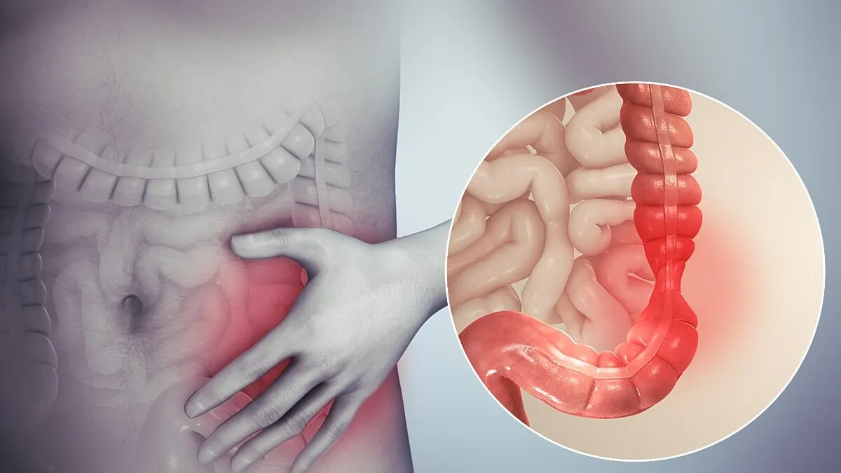 IRRITABLE BOWEL SYNDROME 1